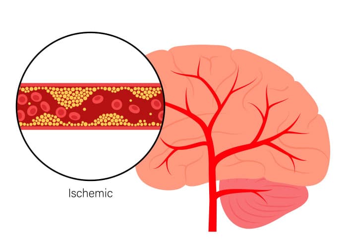 utah-stroke-recovery-and-rehab-dignity-home-health-and-hospice